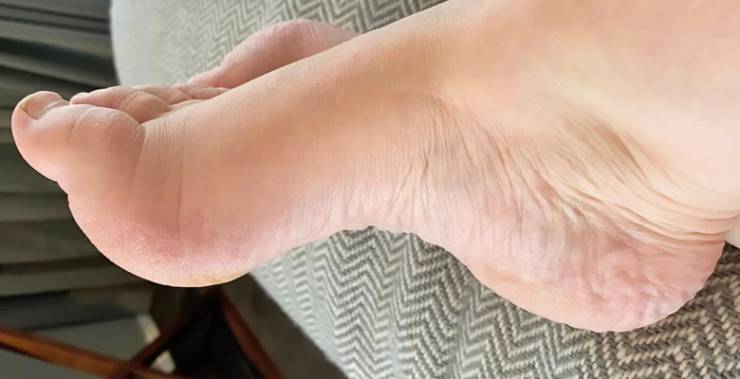 Charcot Marie Tooth Hastalığı Nedir? Belirtileri ve Tedavisi