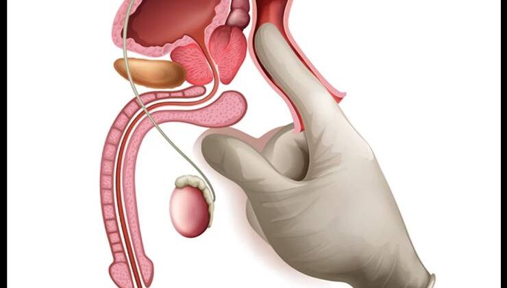 Erkeklerin Gizli Korkusu: Her Prostat Büyümesi Kanser Değil!