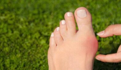 Halluks Valgus Nedir? Belirtileri, Koruyucu ve Cerrahi Tedavisi
