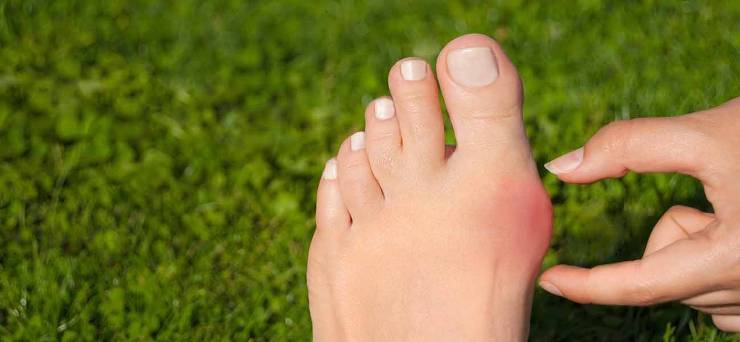 Halluks Valgus Nedir? Belirtileri, Koruyucu ve Cerrahi Tedavisi