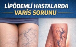 Lipödemli Hastalarda Varis Sorunu: Tedavide Öncelik Ne Olmalı?