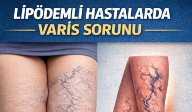 Lipödemli Hastalarda Varis Sorunu: Tedavide Öncelik Ne Olmalı?