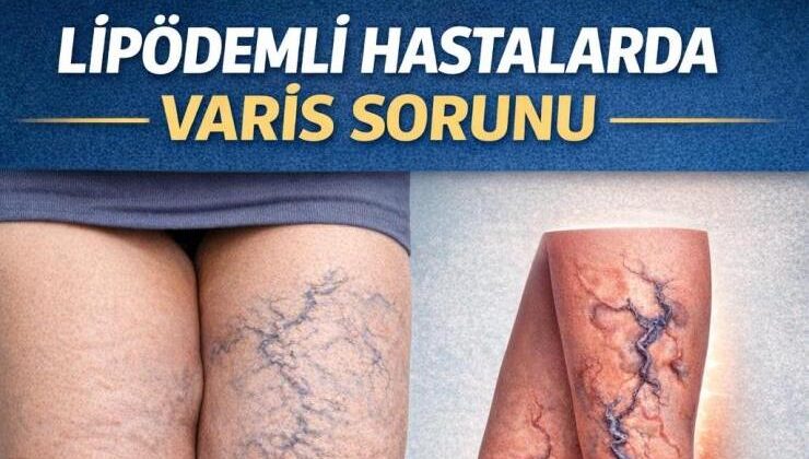 Lipödemli Hastalarda Varis Sorunu: Tedavide Öncelik Ne Olmalı?