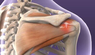 Rotator Cuff Yırtığı Tedavisi ve Omuz Ağrısı Nedenleri