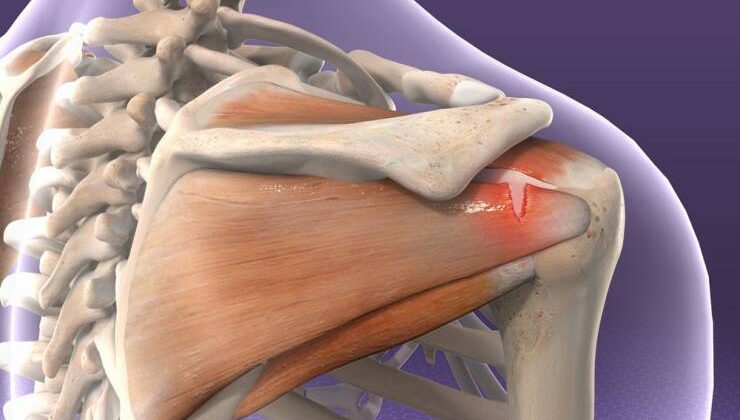 Rotator Cuff Yırtığı Tedavisi ve Omuz Ağrısı Nedenleri