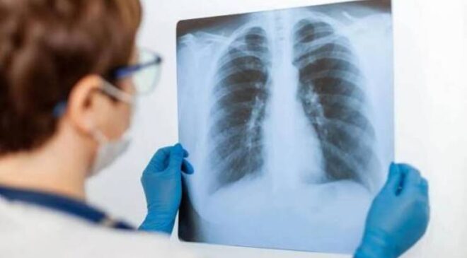 Bronkoskopi (Akciğer Endoskopisi) Nedir? Tanı ve Tedavideki Rolü