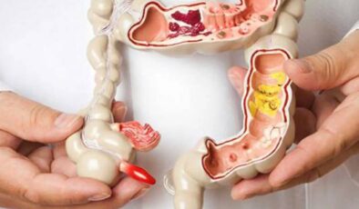 Crohn Hastalığı Nedir? Belirtileri, Teşhisi ve Tedavisi
