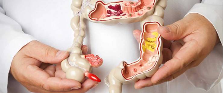 Crohn Hastalığı Nedir? Belirtileri, Teşhisi ve Tedavisi