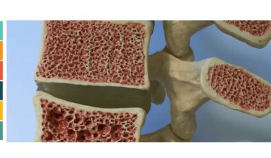Kemik Erimesi Erkekleri de Vuruyor: Osteoporoz Hakkında Bilinmesi Gerekenler
