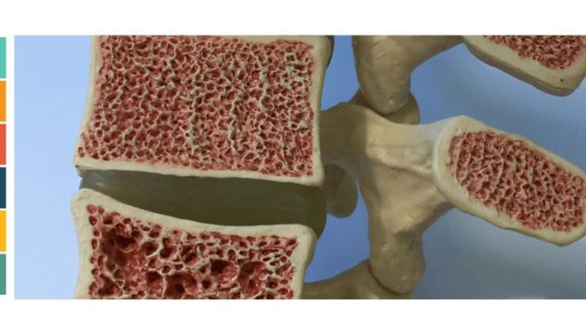 Kemik Erimesi Erkekleri de Vuruyor: Osteoporoz Hakkında Bilinmesi Gerekenler